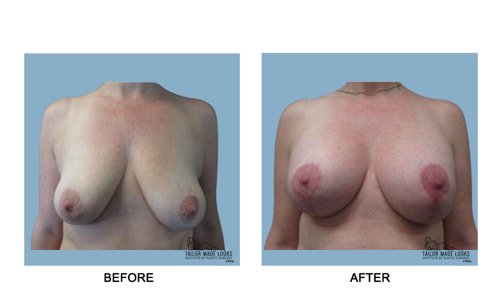 Breast lift + Implant