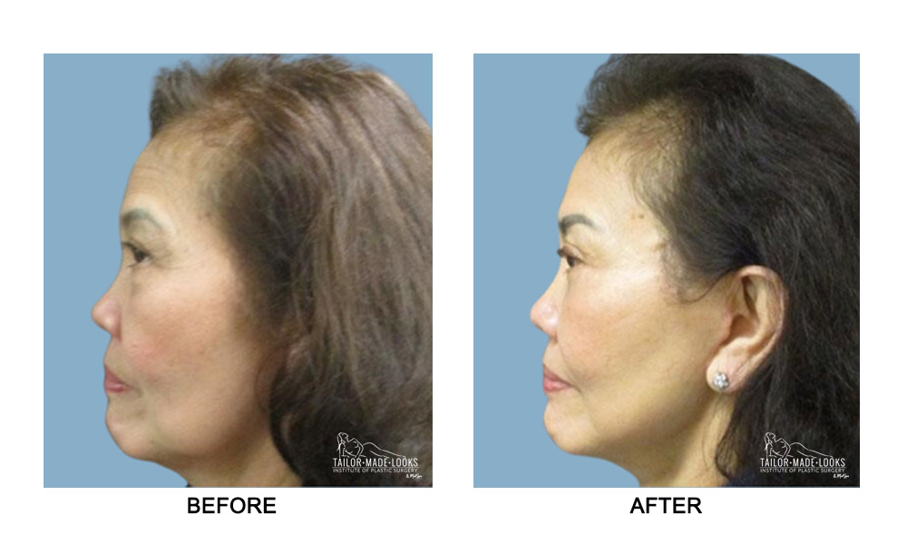 Face surgery images